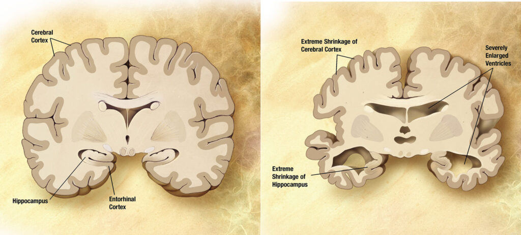 Dementia